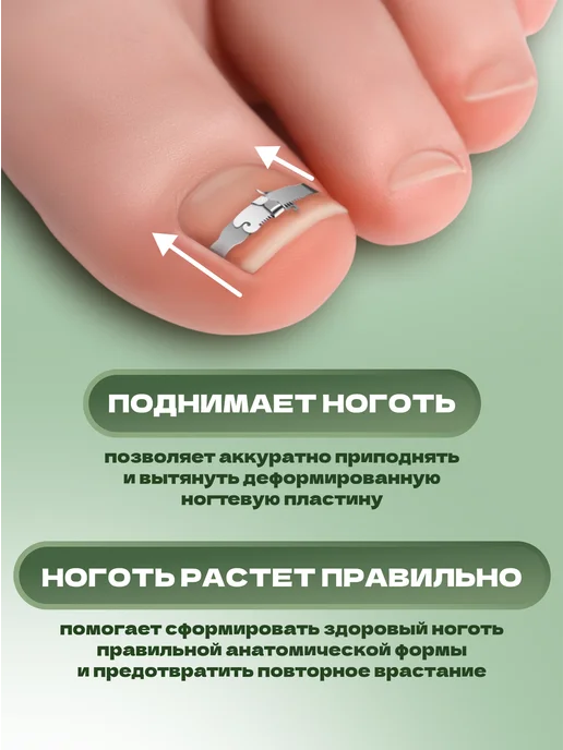 QF Корректор-фиксатор для вросшего ногтя M, серый, фото 3
