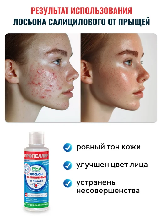 ПРОПЕЛЛЕР Салициловый лосьон от прыщей для комб. кожи, 100 мл, 100 мл, фото 5