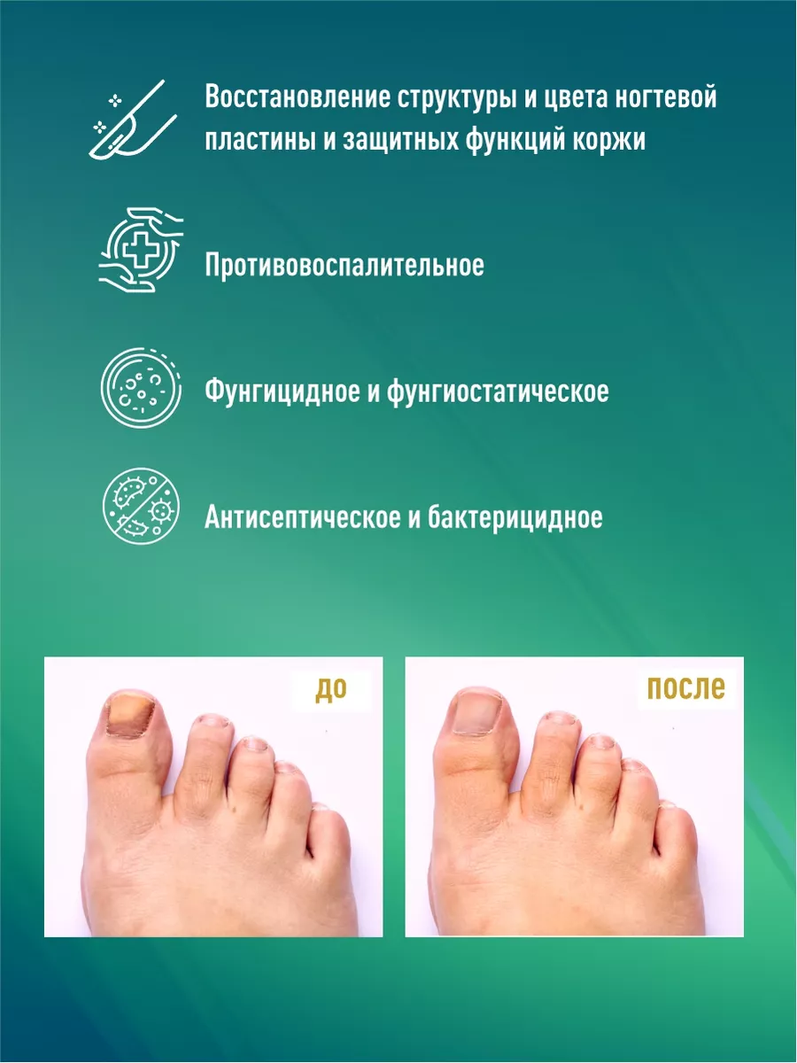 Алфит Плюс Средство от грибка ногтей на ногах крем-гель стоп онихолизис