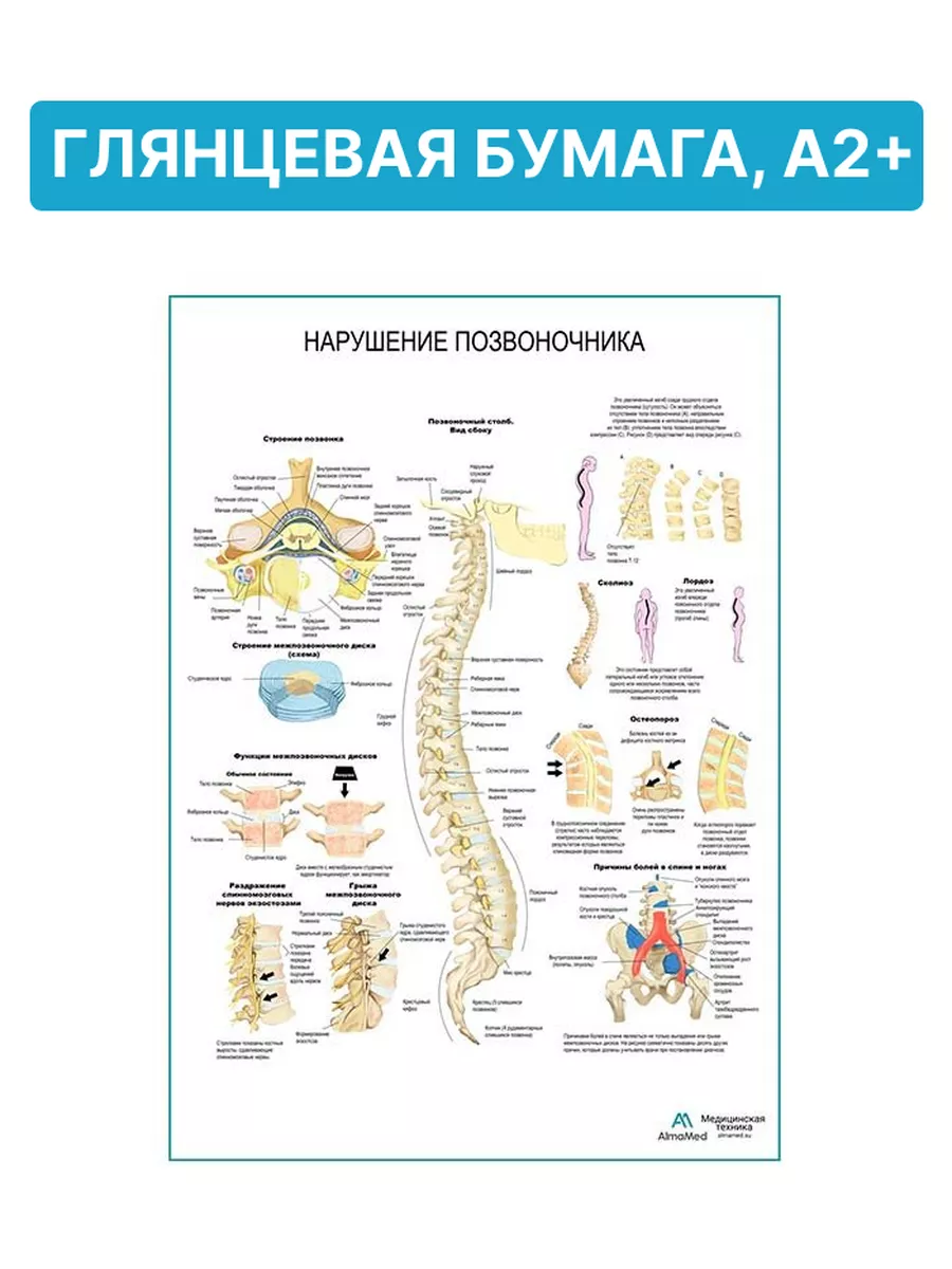 Нарушения позвоночника (анатомия человека) плакат глянцевый Плакаты  188024278 купить за 950 ₽ в интернет-магазине Wildberries